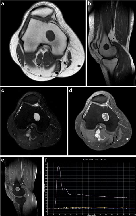 Large cartilaginous tumour centrally located in the distal femur ...