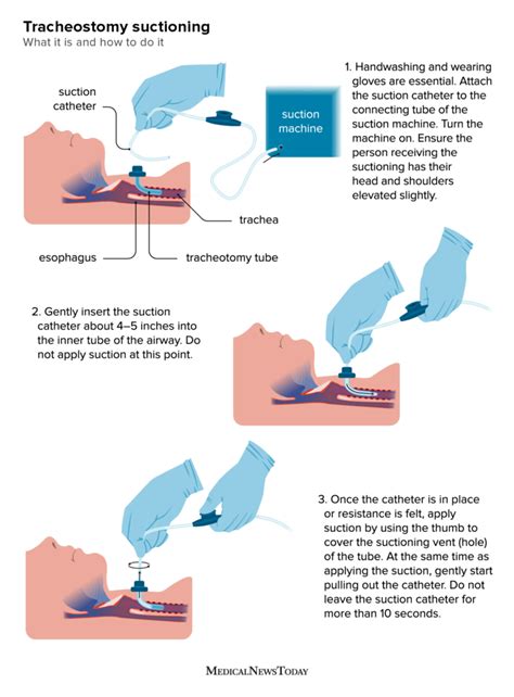 Tracheostomy suctioning: What to know