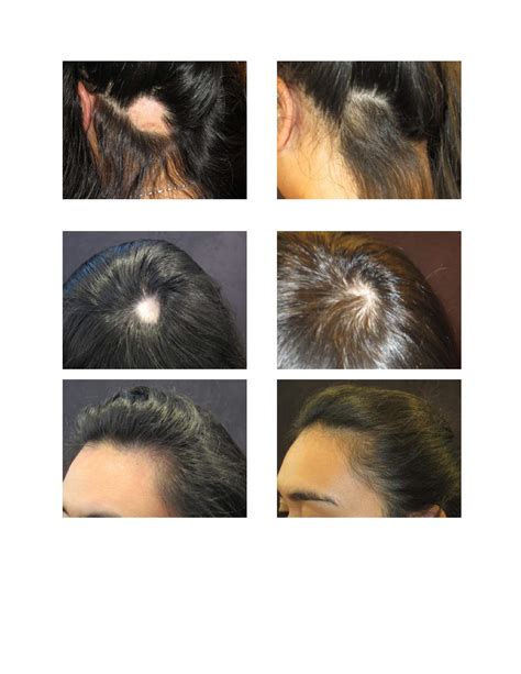 Alopecia Areata and Hair Loss Treatments - Absolique Hair Health Clinic