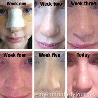 Alcohol Before Rhinoplasty » Rhinoplasty: Cost, Pics, Reviews, Q&A