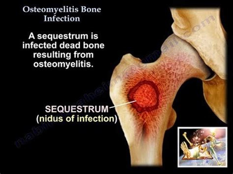 Jaw Bone Infection Symptoms And Osteomyelitis Causes