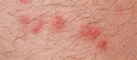 What Do Flea Bites Look Like? | Get Rid of Fleas | Orkin