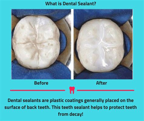 Sealants Before And After - Dental Sealants In San Marcos Larry D Molenda D D S : Silicone ...