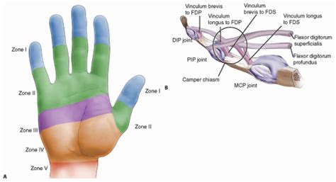 Staged Digital Flexor Tendon Reconstruction | Musculoskeletal Key