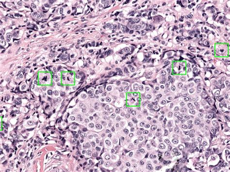 Mitotic figure counting - Aiosyn