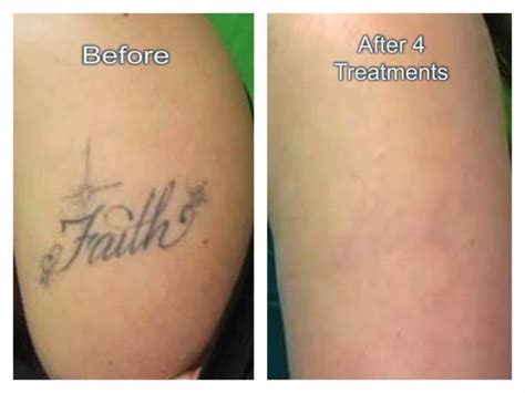 Permanent Laser Tattoo Removal in Dubai - Laser Skin Care Clinic