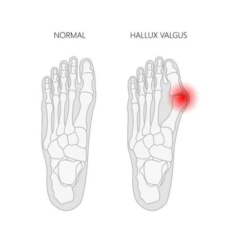 Bunion Causes, Symptoms, and Treatment | BioSkin Bracing