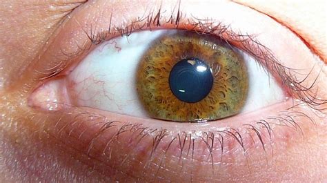 Stages of Intraocular (Uveal) Melanoma | SERO