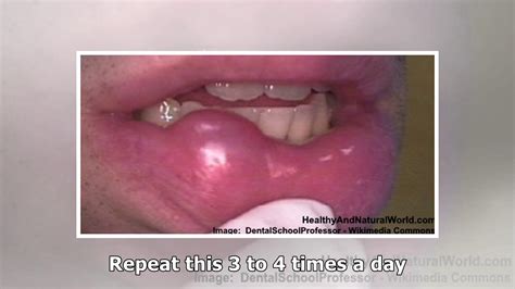 Bumps on Lips: Causes and Top Natural Treatments - YouTube