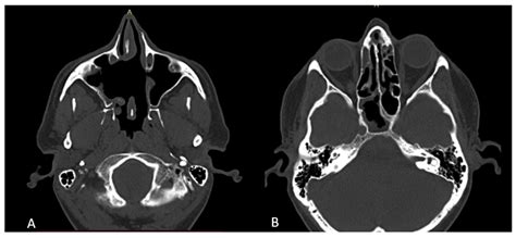 Endoscopic Excision of Rare Large Maxillary Sinus Osteoma: A Case Report and Literature Review