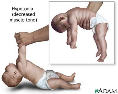 Muscle Hypotonia; Flaccid Muscle Tone; Hypotonia