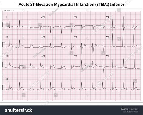 Pentru 12 lead ekg stemi sunt 4 imagini, fotografii de stoc și vectori ...