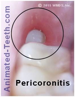 Pericoronitis (wisdom tooth infection). Causes & treatment.