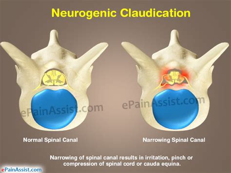 What is Neurogenic Claudication and How is it Treated?