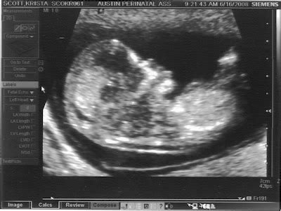 THE SCOTT FAMILY: Nuchal Translucency Ultrasound