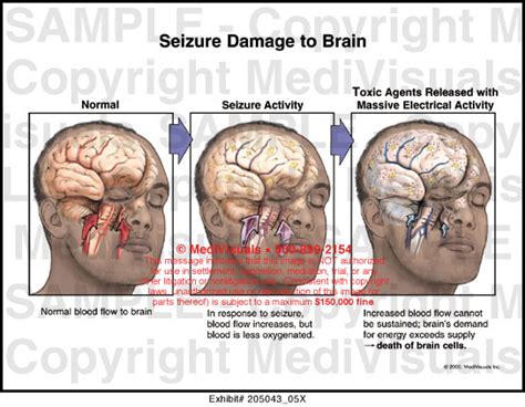 Medivisuals Seizure Damage to Brain Medical Illustration