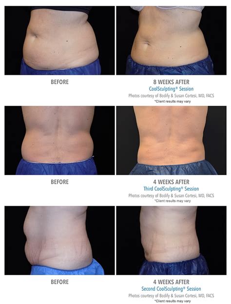 CoolSculpting Before & After Photos | Client Results | Bodify Arizona