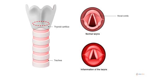 Laryngitis | Types, Symptoms, Causes and Treatment