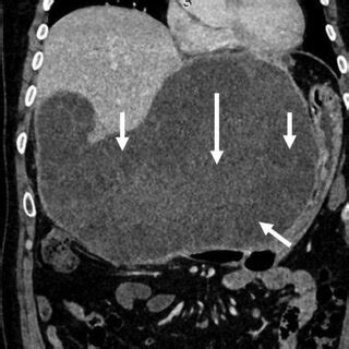 Hydatid cyst: Ultrasound. Multiple stages of hydatid cyst are shown.... | Download Scientific ...