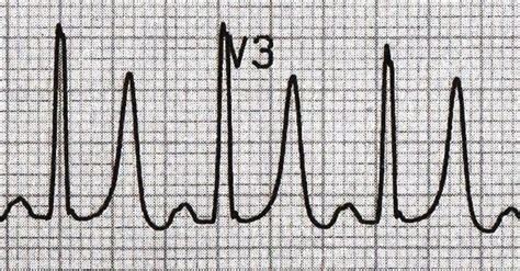 T wave • LITFL • ECG Library Basics