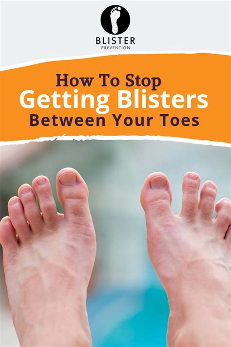 Blisters Between Toes: 7 Expert Ways To Prevent | Blisters, Toes, Prevention