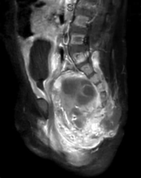 Sacrococcygeal Teratoma • APPLIED RADIOLOGY