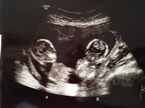 New twin ultrasound pic!! | BabyCenter