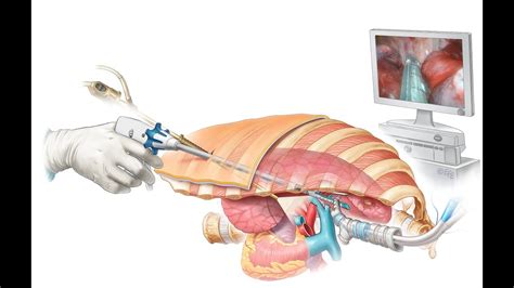 Minimal invasive surgery for lung cancer - YouTube