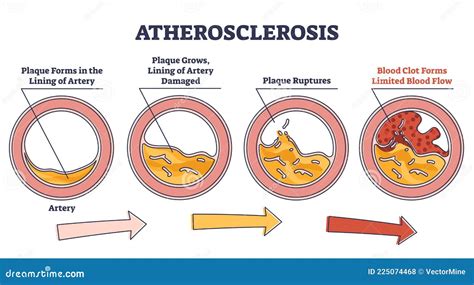 Plaque Formation In Artery Vector Illustration | CartoonDealer.com ...