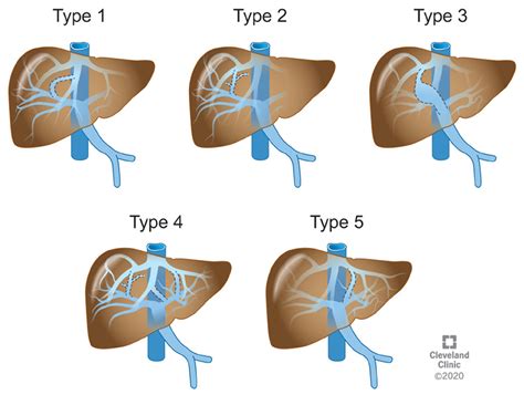 Vascular anomalies associated with hepatic shunting