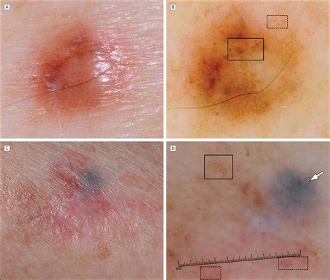 Clinical and Dermoscopic Characteristics of Desmoplastic Melanomas | Dermatology | JAMA ...