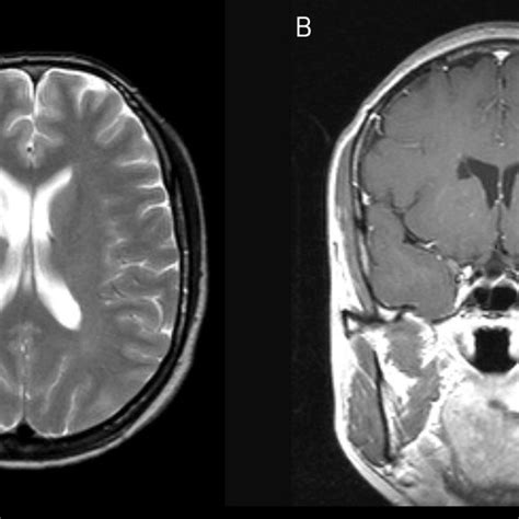 (PDF) A Case of Isolated Traumatic Caudate Lesion with Marked Improvement in Visuospatial ...