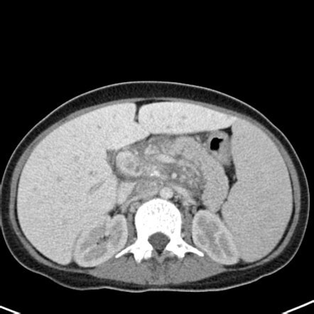 Hepatic hemosiderosis | Radiology Reference Article | Radiopaedia.org