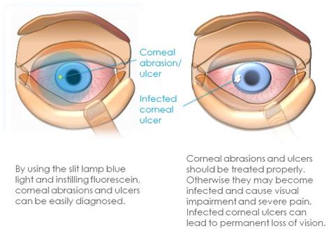 Corneal Ulcer: Symptoms, Causes, And Treatment | EyeMantra