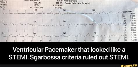 Ventricular Pacemaker that looked like a STEMI. Sgarbossa criteria ...