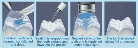 Fissure Sealant - BPA free - Dentist @ Clyde | Dental | Dentist | City of Casey | Victoria