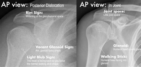 Posterior Shoulder Dislocation – EMbeds.co.uk