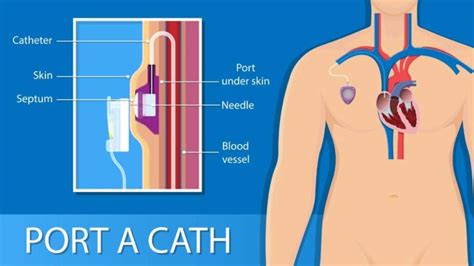 Port-a-Cath Español - El Paso, TX: Imaging & Interventional Specialists