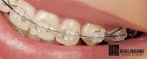 AFFORDABLE DENTAL BRACES FOR ADULTS - Burlingame Smile Studio