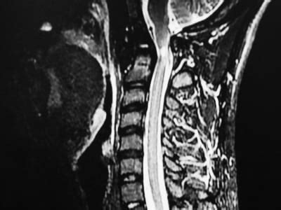 Os Odontoideum: Rare Cervical Lesion - The Western Journal of Emergency Medicine