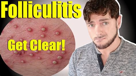 Folliculitis Ingrown Hair Bumps