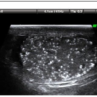 (PDF) Testicular Microlithiasis among Infertile Men: A Reason for Concern?