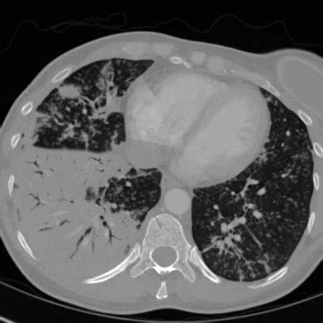 CT scan of the chest, axial view, with tree in bud opacities, bilateral ...