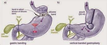 Medical Treatment Pictures-for Better Understanding: Vertical Banded ...