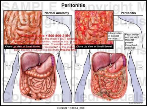 7. peritonitis