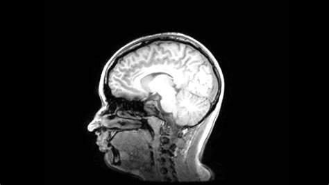 My Brain - MRI Scan Result Images - YouTube