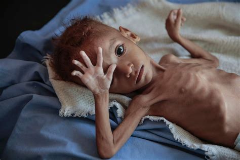 85,000 children in Yemen have starved to death: Save the Children report - ABC News