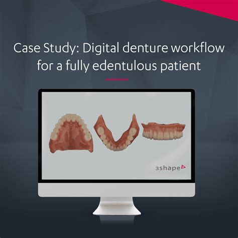 Digital denture workflow for a fully edentulous patient | Case study