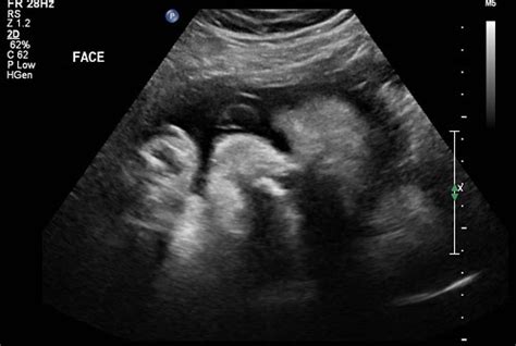 36 Week Ultrasound | Rebecca Mongrain's Blog