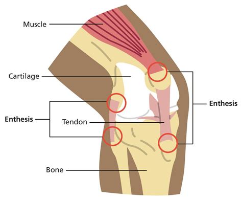 Enthesitis-related arthritis (ERA) - Resource Library - Sheffield Children's NHS Foundation Trust